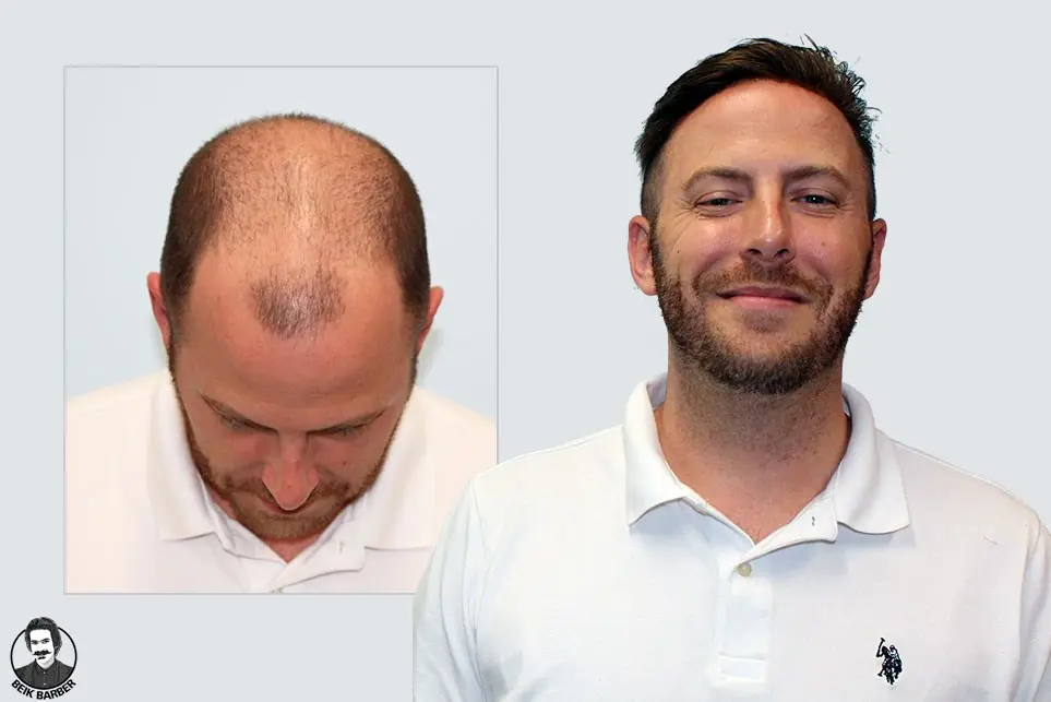 روش های اتصال پروتز مو روی سر